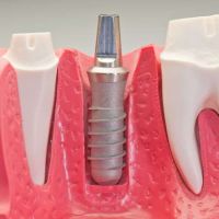 Studio Dentistico Belvedere - Servizi - Implantologia