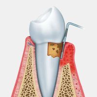 Studio Dentistico Belvedere - Servizi - Parodontologia